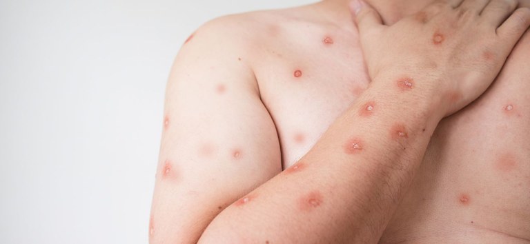 Casos de Mpox reacendem alerta: Confira cuidados, sintomas e formas de prevenção